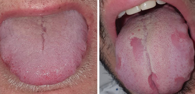 What is Covid Tongue?